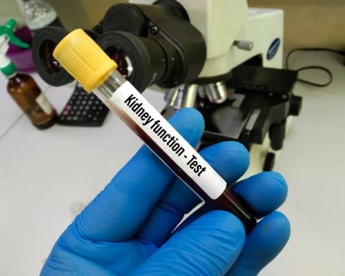 When Should I get a Kidney KFT test? What Symptoms should I watch for?