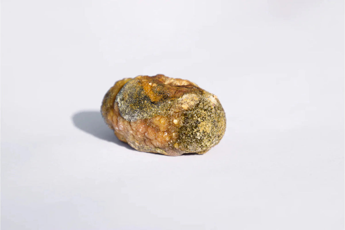 How are Gallstones Formed? What are the Risk Factors & Treatments?
