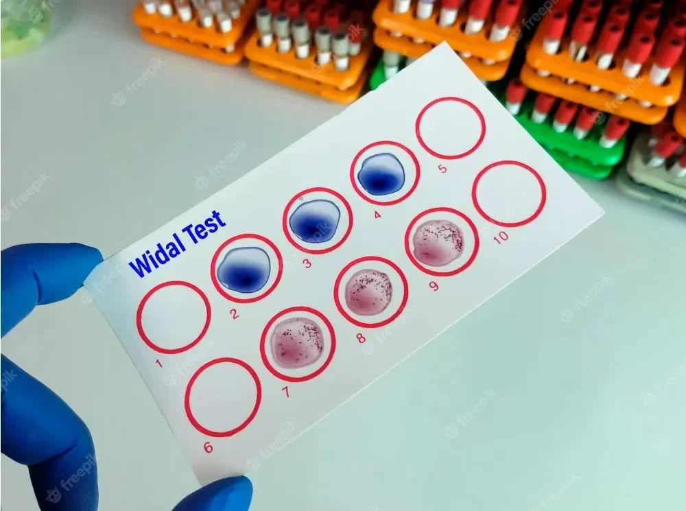 Widal Test vs. Blood Culture: Which Is Better for Diagnosing Typhoid?