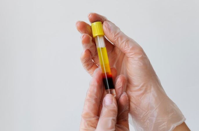 Alkaline phosphate blood test