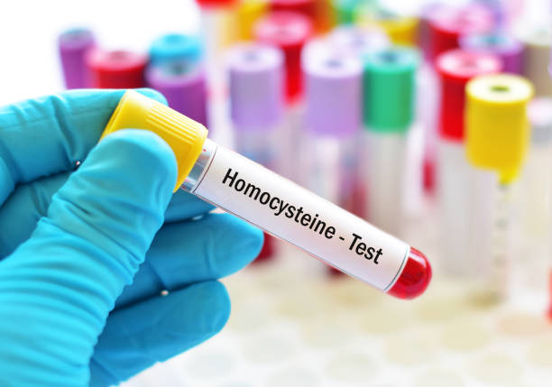 Homocysteine Blood Test | Homocysteine Levels | Cardiovascular Disease