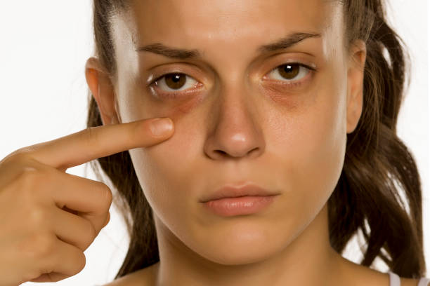 How to Remove Dark Circles | Prevent Dark Circles | Circles Under the Eyes