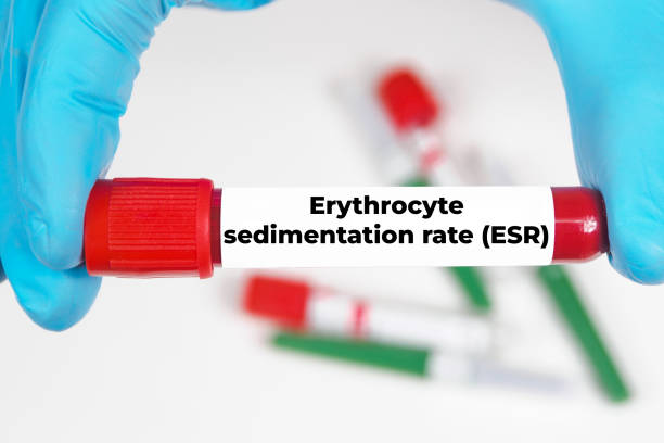 ESR Test Means | High ESR Symptoms | ESR High Means | Erythrocyte Sedimentation Rate |