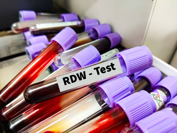 RDW Blood Test: Meaning, Normal Range, High & Low Levels