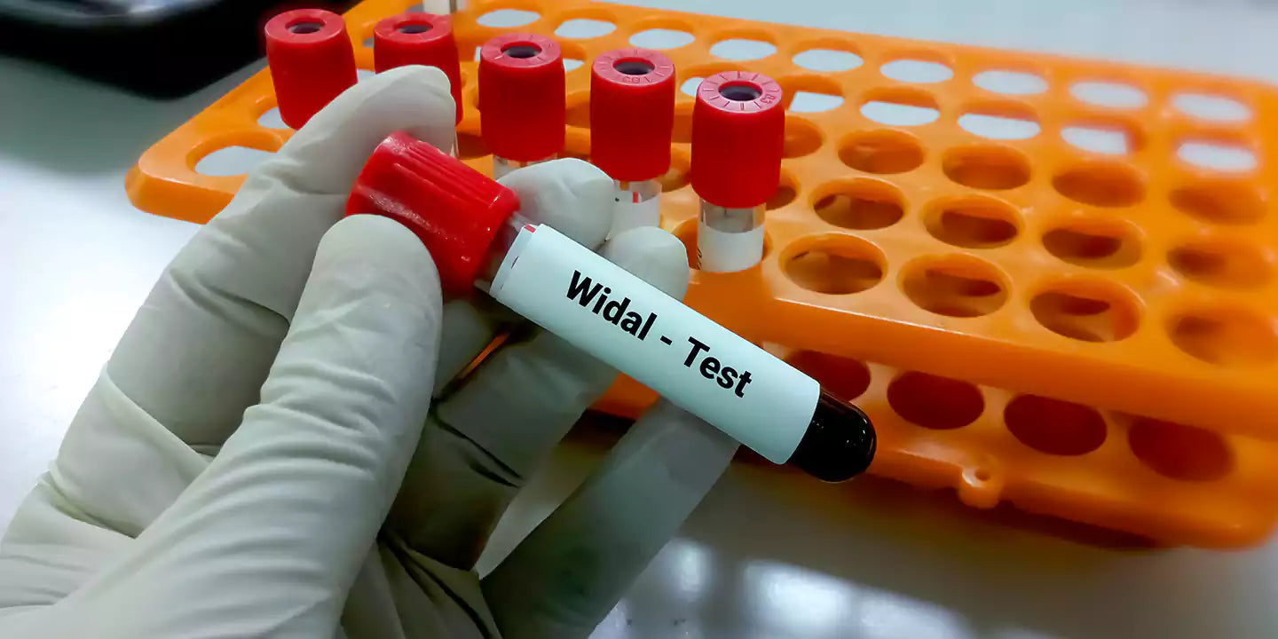 When Should You Get a Widal Test? Early Symptoms of Typhoid Fever to Watch