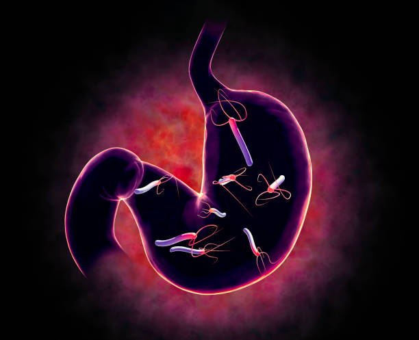 Does H. Pylori Cause Stomach Cancer? Risk, Symptoms, and How It Differs From an Ulcer