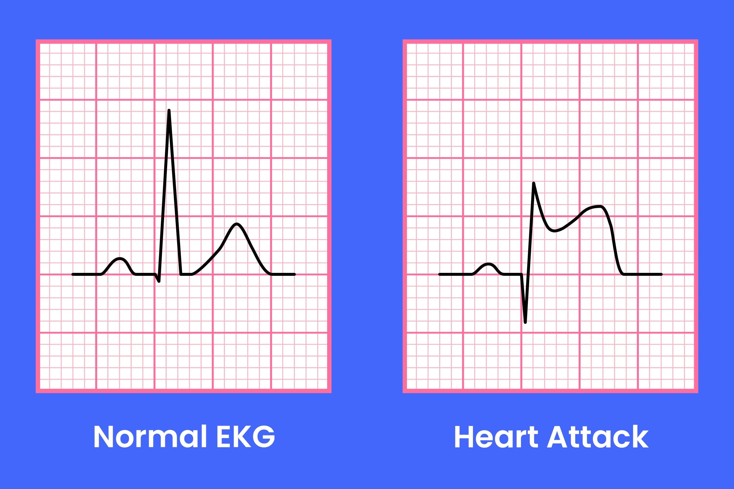 Can an ECG Test Predict a Heart Attack? Understanding the Limitations