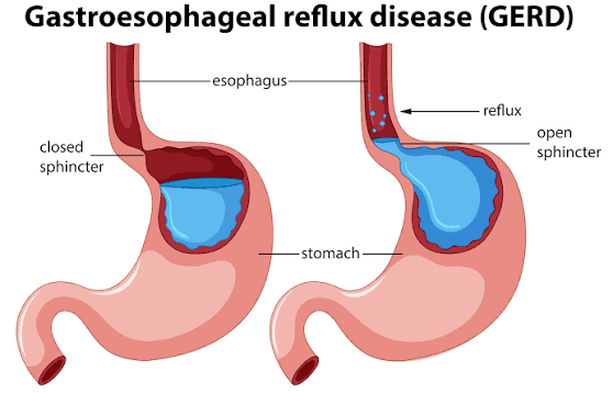 Gastroesophageal Reflux Disease GERD: Causes, Symptoms, Tests & Treatment Guide