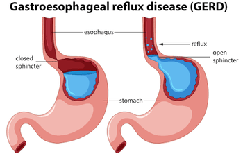 Gastroesophageal Reflux Disease GERD: Causes, Symptoms, Tests & Treatment Guide
