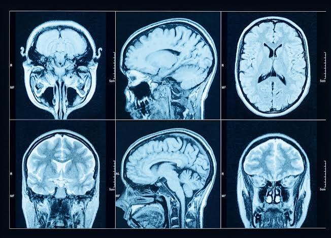 MRI Brain Age Test: What It Is, How Accurate It Is & What It Costs