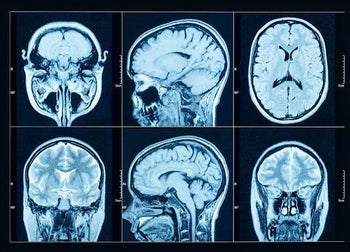 MRI Brain Age Test: What It Is, How Accurate It Is & What It Costs