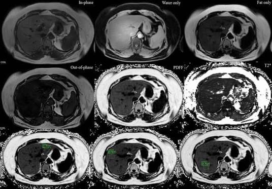 Liver Fat Quantification (PDFF) Explained: MRI vs. Blood Tests vs. Ultrasound