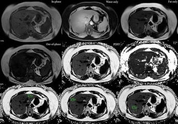 Liver Fat Quantification (PDFF) Explained: MRI vs. Blood Tests vs. Ultrasound