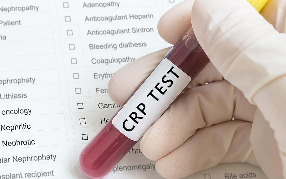 What if CRP is High in Blood test? What are the Next steps?