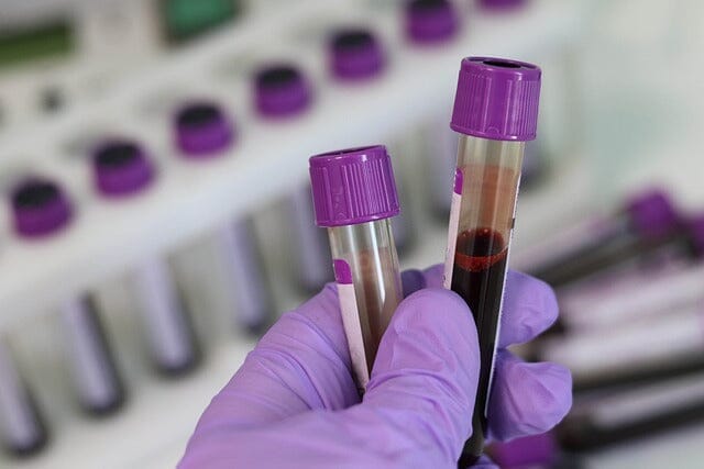 Why get a creatinine test? What's the serum creatinine normal range?