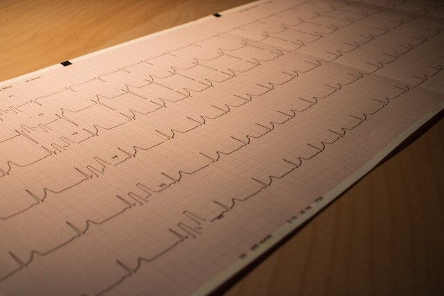 Here's what a TMT Test Positive means for your Cardiac Health