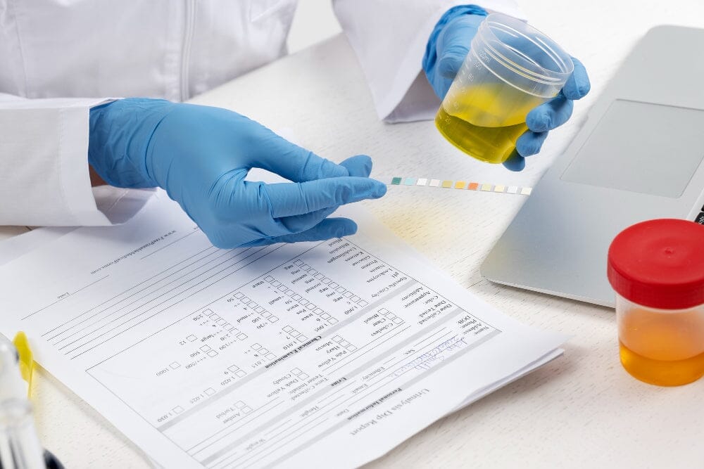 What is Urine Culture? How to get the best Urine Culture test price