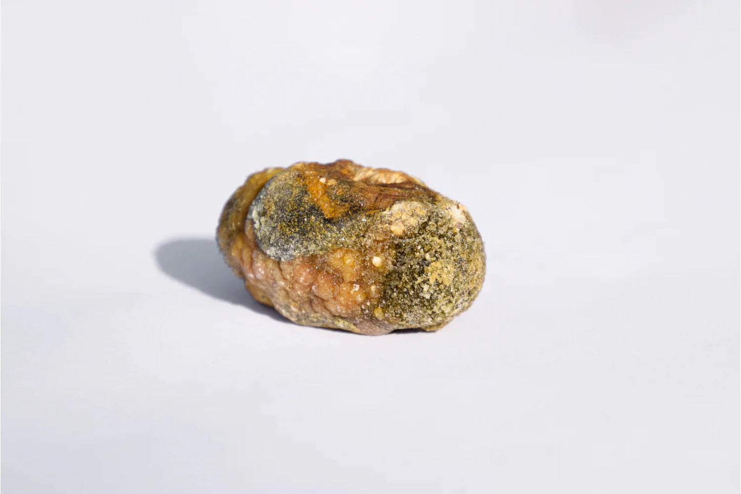 How are Gallstones Formed? What are the Risk Factors & Treatments?