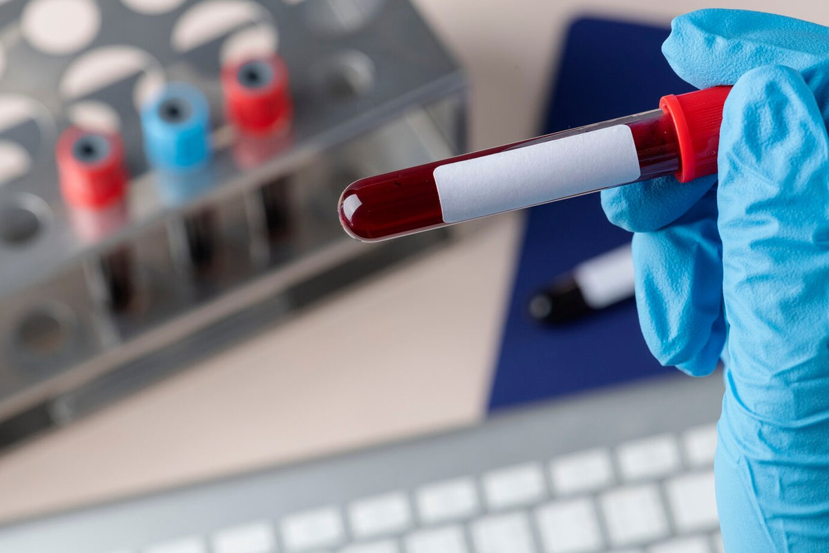 AST Blood Test: Understanding Normal Levels, High Readings, and Liver Health Risks