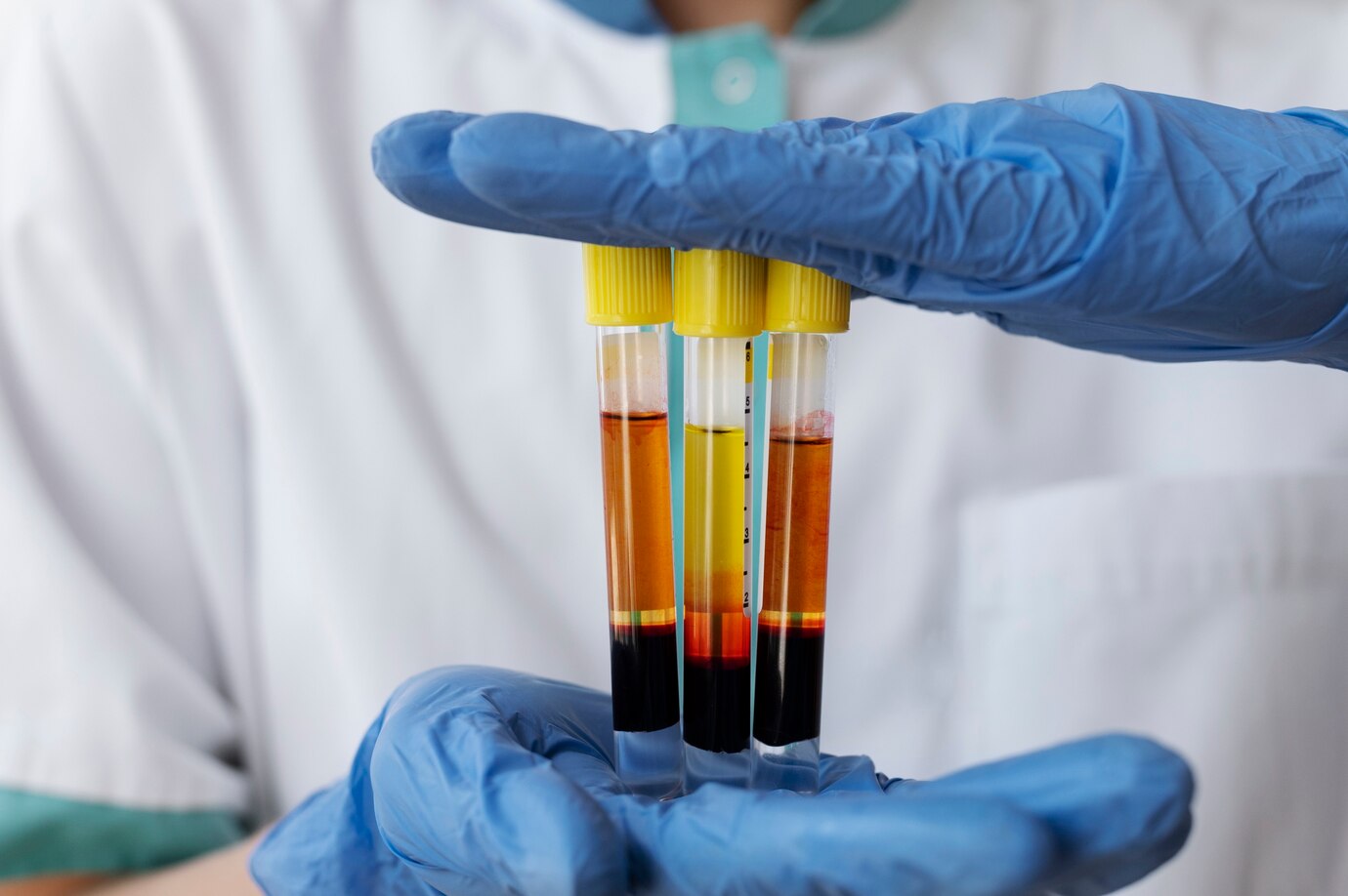 Albumin Levels Explained: Normal Ranges, Tests & What Trace Means in Urine