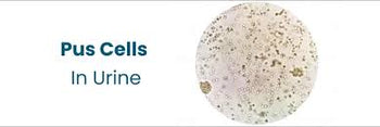 Pus Cells in Urine and Stool: Normal Ranges and What They Mean