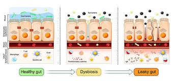 Gut Dysbiosis