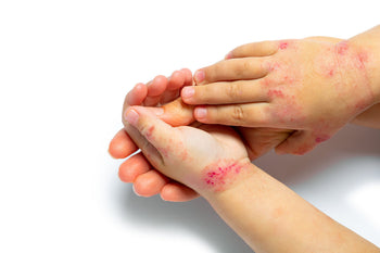 Understanding the Food Allergy Eczema Connection: Can Food Allergies Cause Eczema or Asthma?