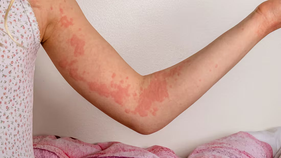 Unexplained Rash After Eating? It Could Be a Food Allergy