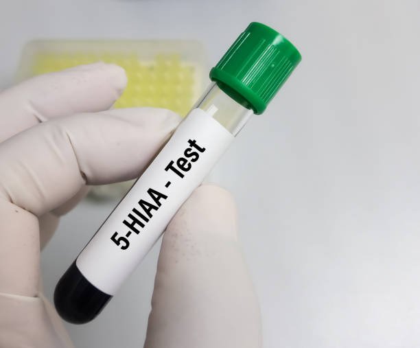  5-HIAA Urine Test | 5-HIAA Test