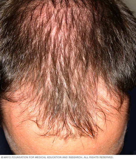 Heavy Metal Hair Loss: Causes, Diagnosis, and Management