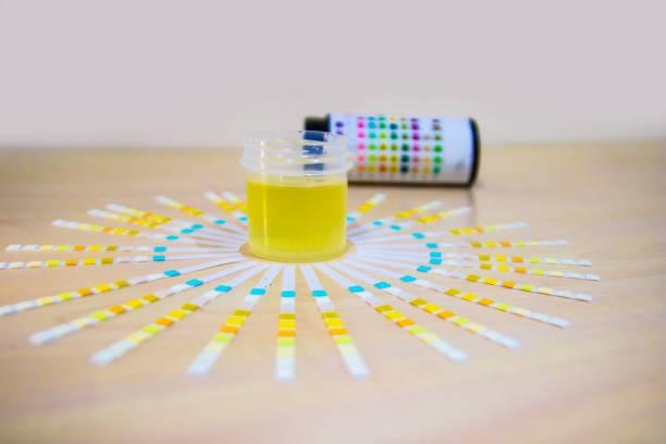 Glucose in Urine | urine sugar levels 