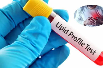 Why Lipid Profile Test Is Done in Fasting: Fasting Time, Reasons, and What You Need to Know