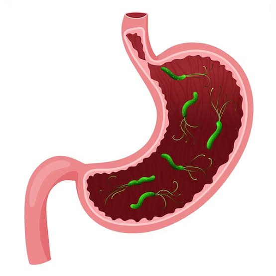 Difference Between H. pylori IgG and IgM: Interpretation, Normal Range, and Test Meaning