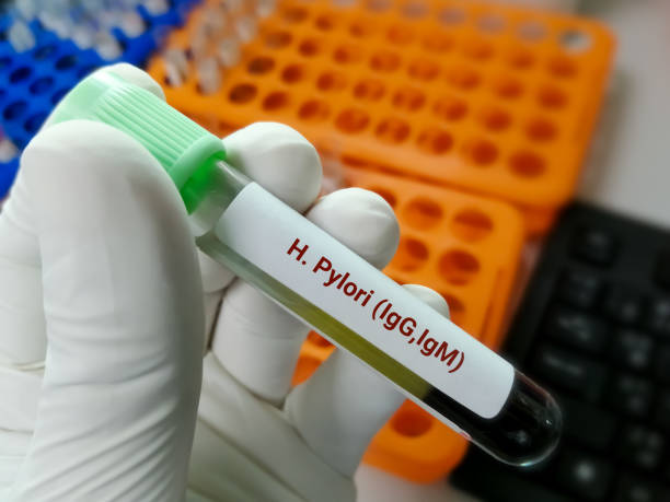 H. pylori Stool Test vs Blood Test