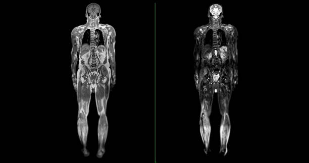 Whole Spine MRI