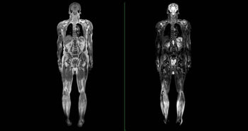 Whole Spine MRI